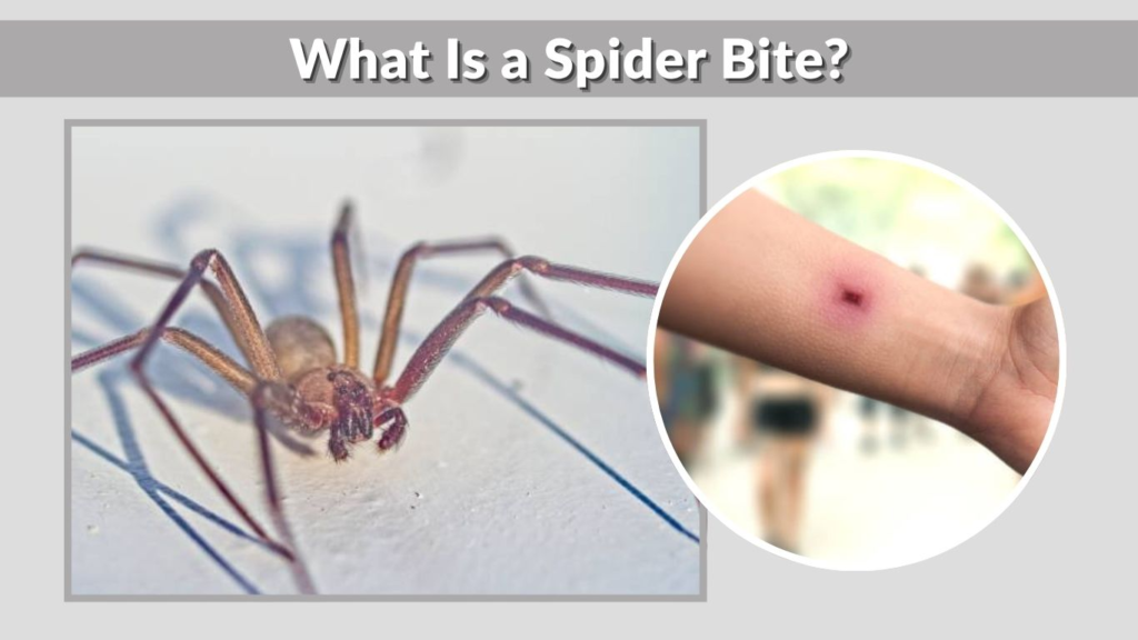 What Is a Spider Bite?