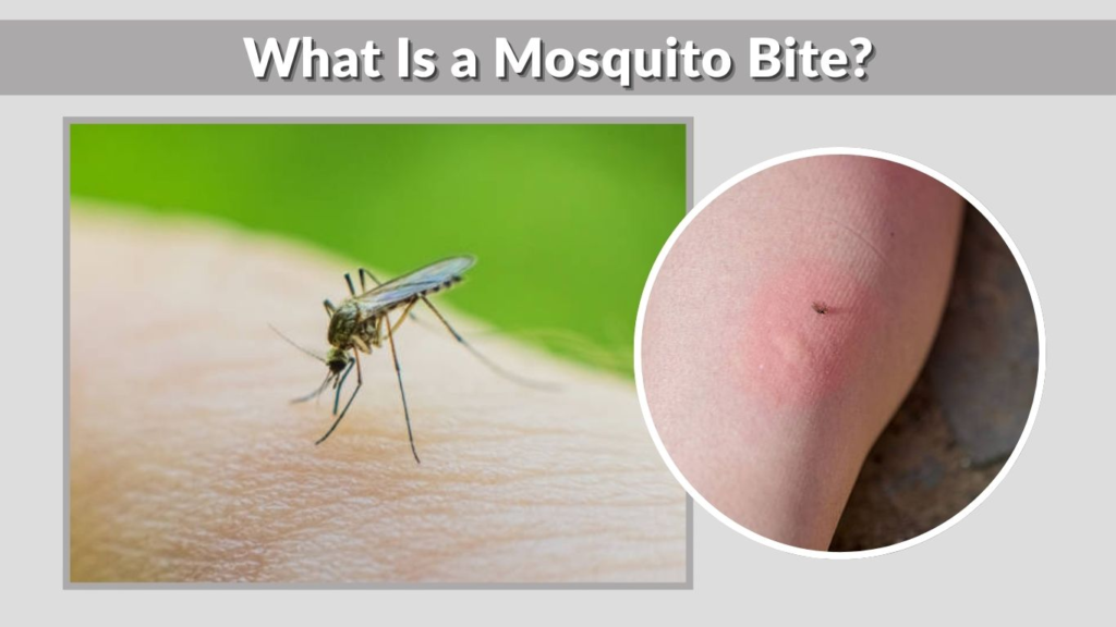 What Is a Mosquito Bite?