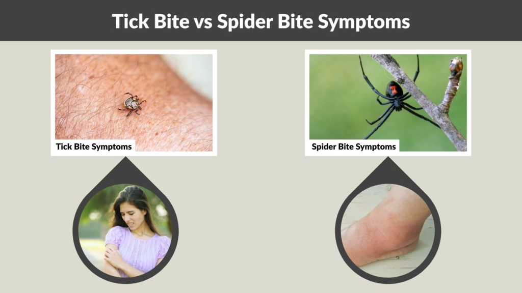 Tick Bite vs Spider Bite Symptoms