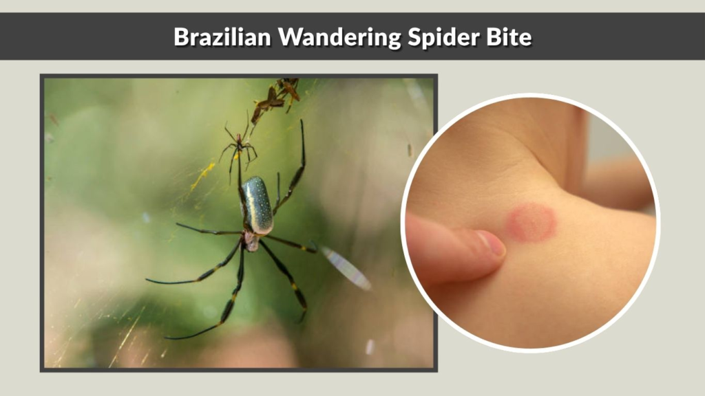 Brazilian Wandering Spider Bite