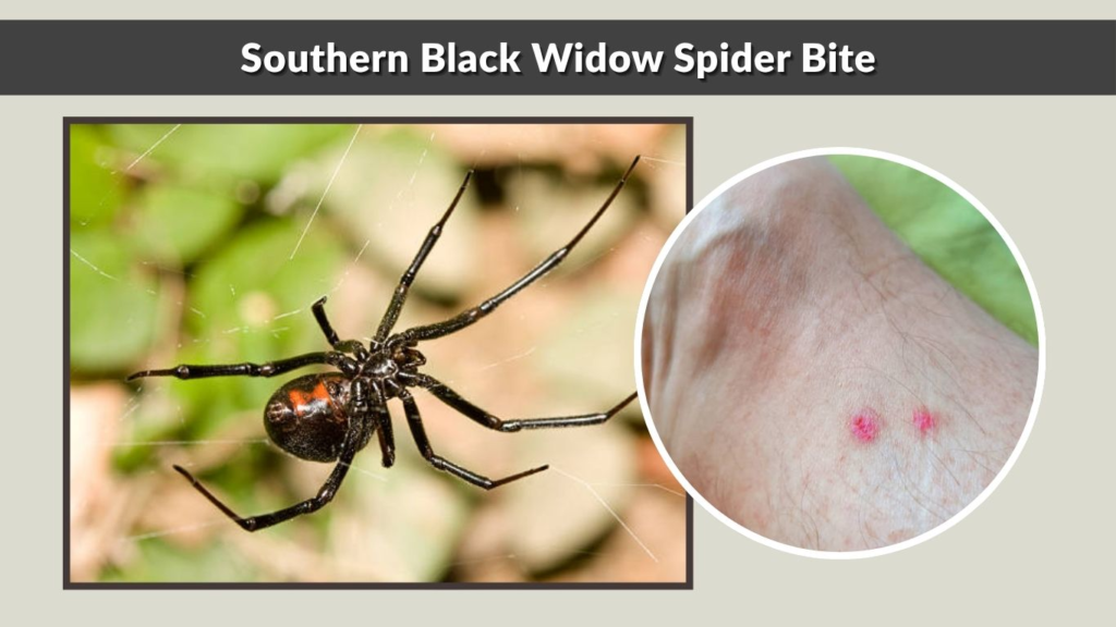 Southern Black Widow Spider Bite