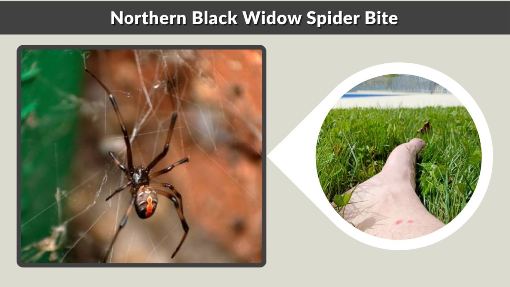 Northern Black Widow Spider Bite