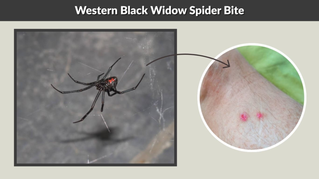 Western Black Widow Spider Bite
