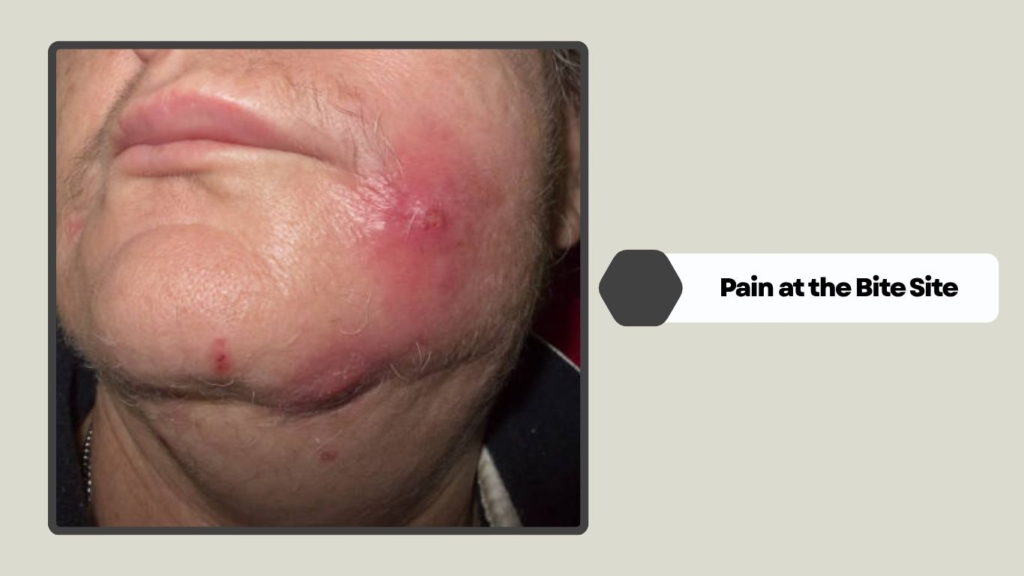 Pain at the Bite Site