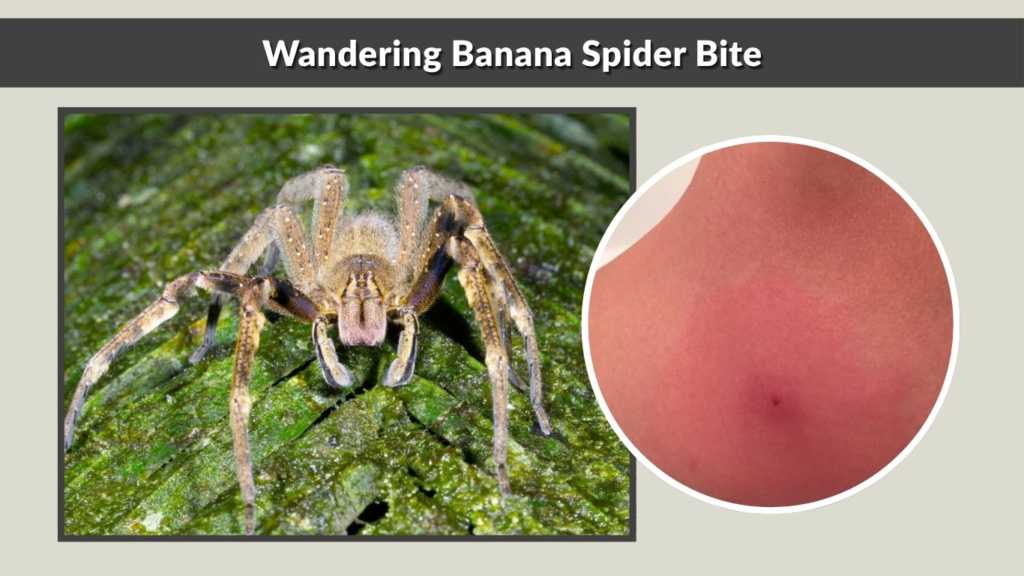 Wandering Banana Spider Bite