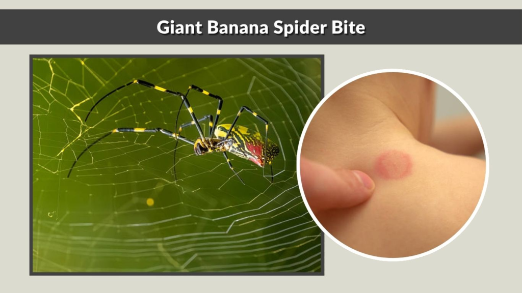 Giant Banana Spider Bite