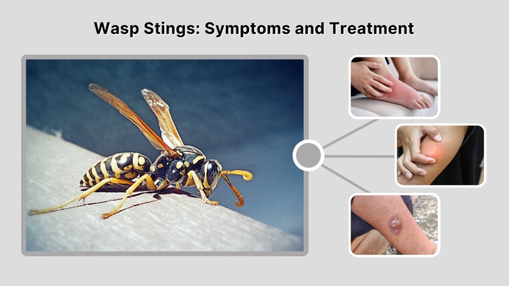 Wasp Stings: Symptoms and Treatment