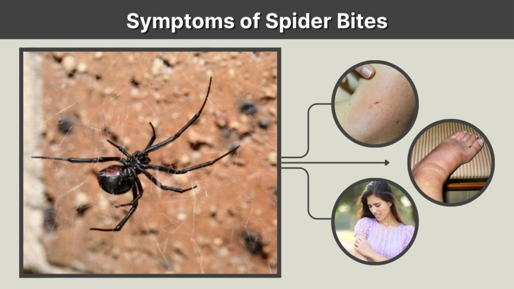 Symptoms of Spider Bites