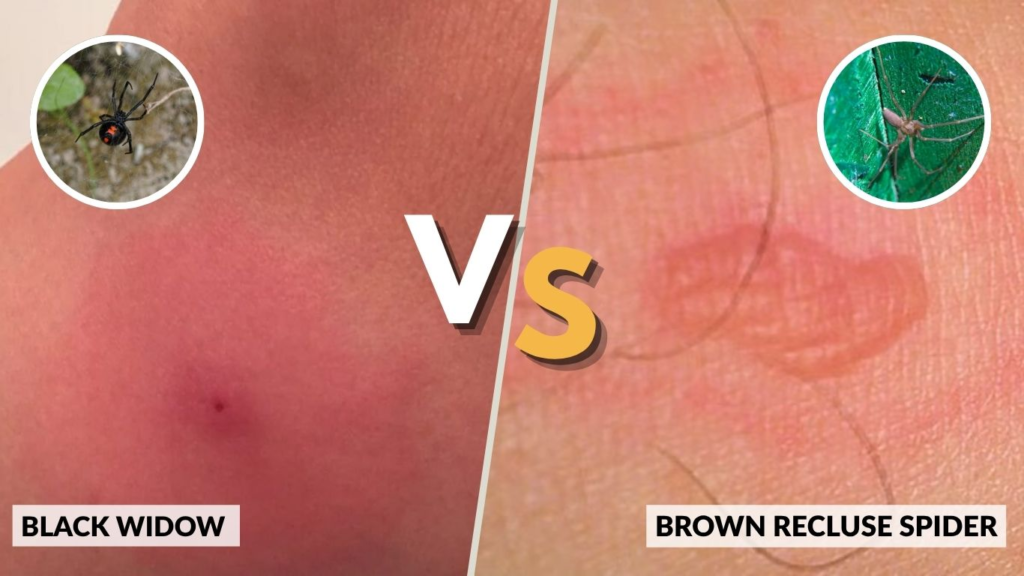 Black Widow vs Brown Recluse Spider Bites