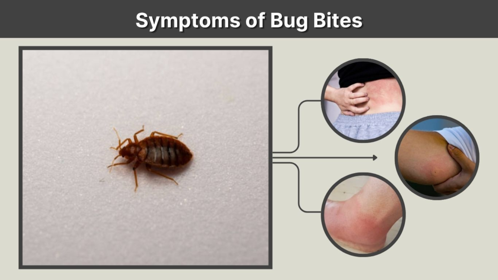 Symptoms of Bug Bites