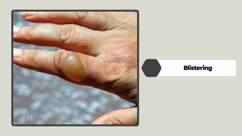 Blistering