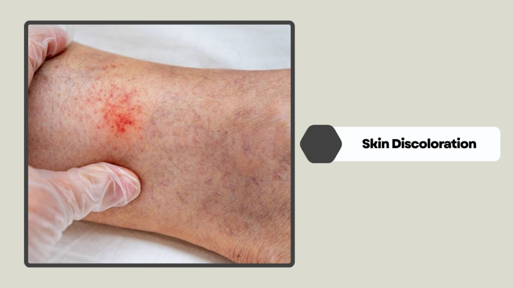 Skin Discoloration