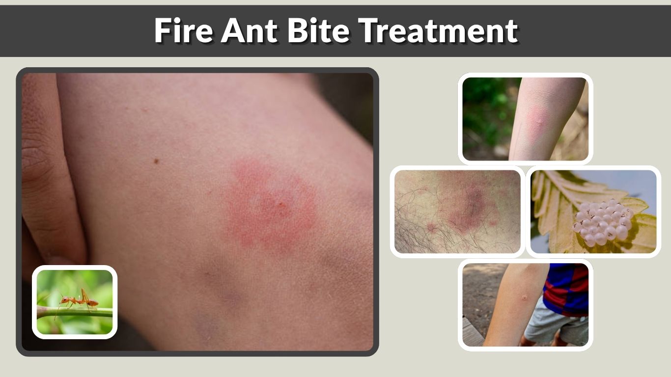 Fire Ant Bite Treatment for Swelling, Pain and Itching