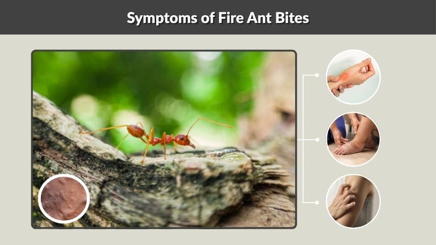 Symptoms of Fire Ant Bites