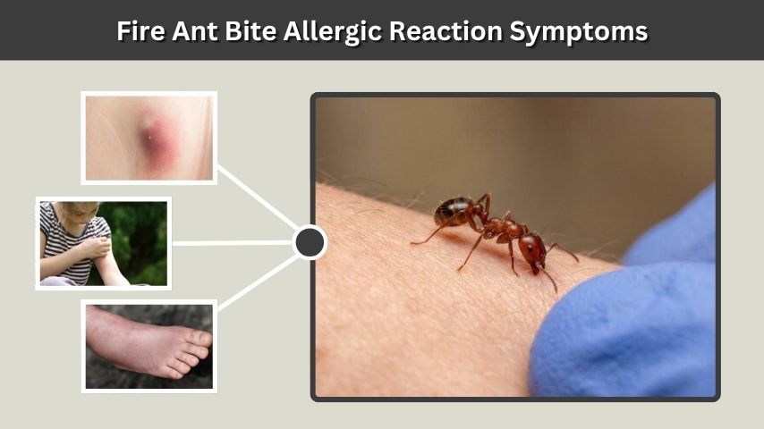 Fire Ant Bite Allergic Reaction Symptoms