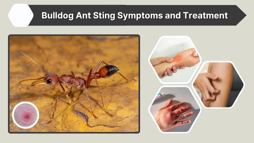 Bulldog Ant Sting Symptoms and Treatment