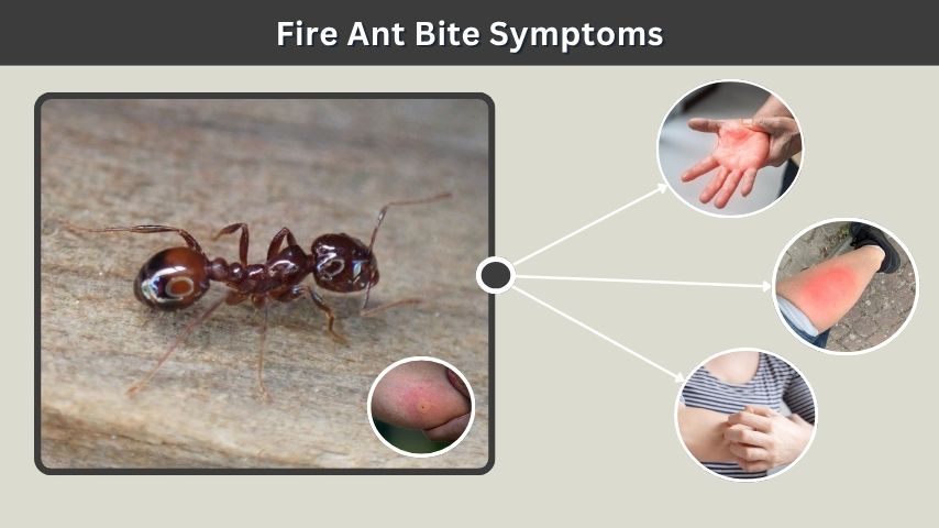 Fire Ant Bite Symptoms