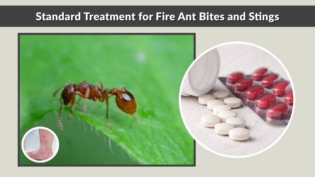 Standard Treatment for Fire Ant Bites and Stings