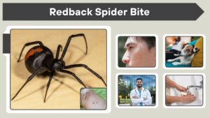 Redback Spider Bite: Symptoms, First Aid and Treatment