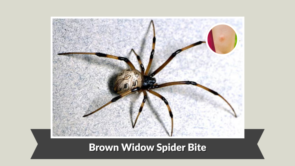 Brown Widow Spider Bite