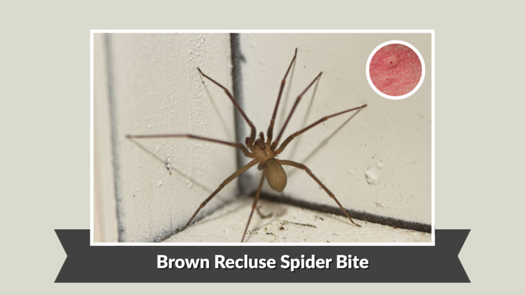 Brown Recluse Spider Bite