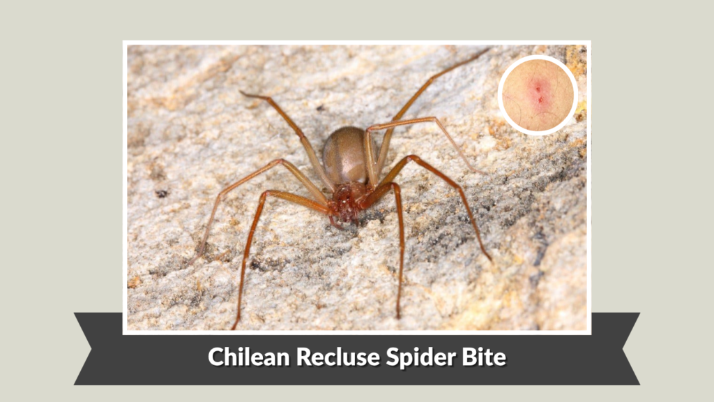 Chilean Recluse Spider Bite