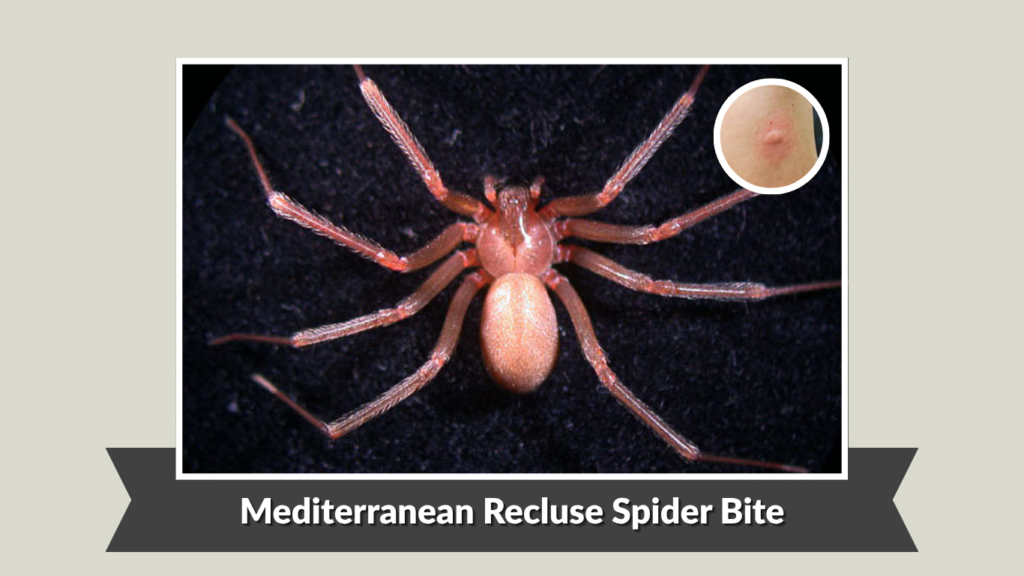 Mediterranean Recluse Spider Bite