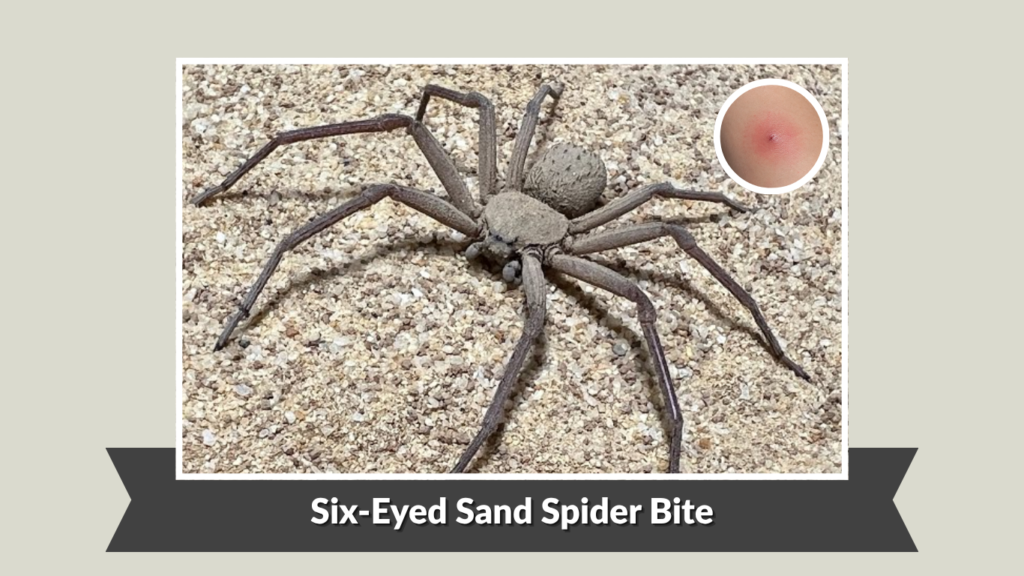 Six-Eyed Sand Spider Bite