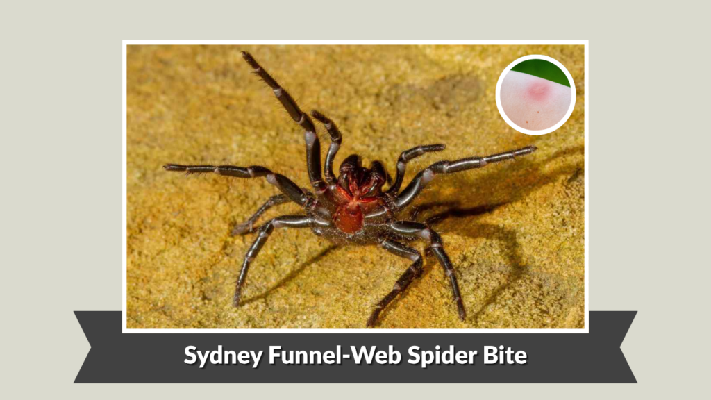 Sydney Funnel-Web Spider Bite