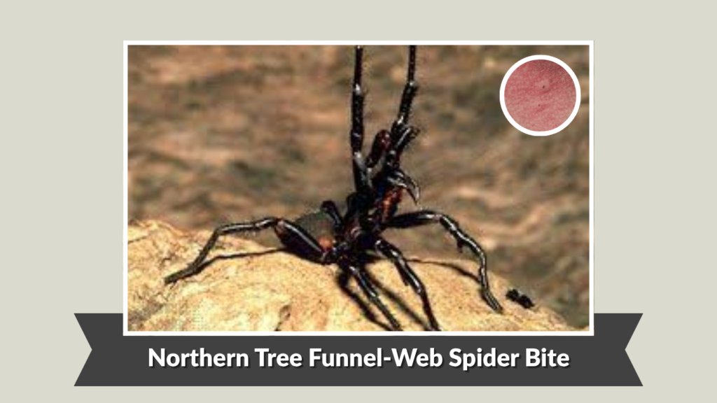 Northern Tree Funnel-Web Spider Bite