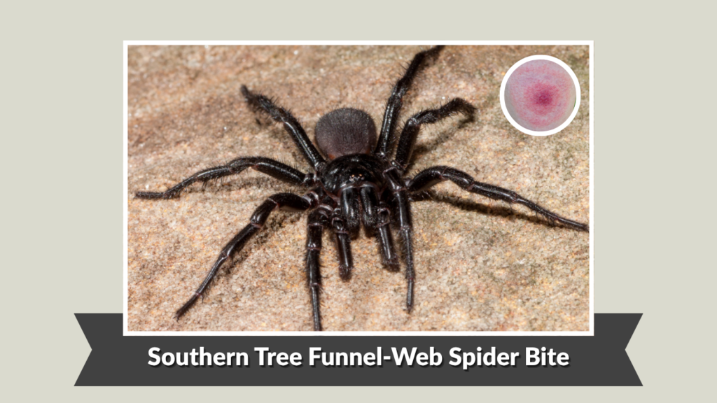 Southern Tree Funnel-Web Spider Bite