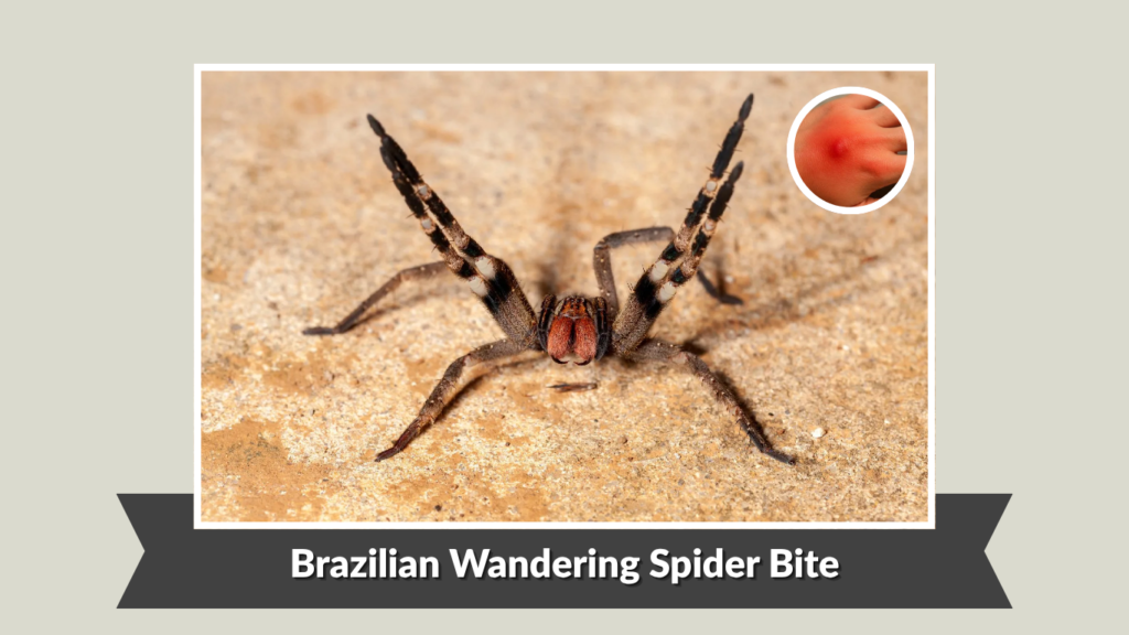 Brazilian Wandering Spider Bite