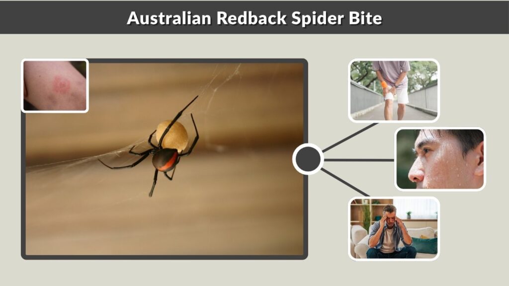 Australian Redback Spider Bite