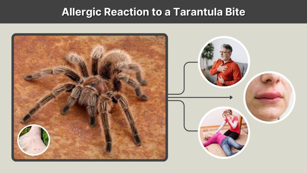 Allergic Reaction to a Tarantula Bite