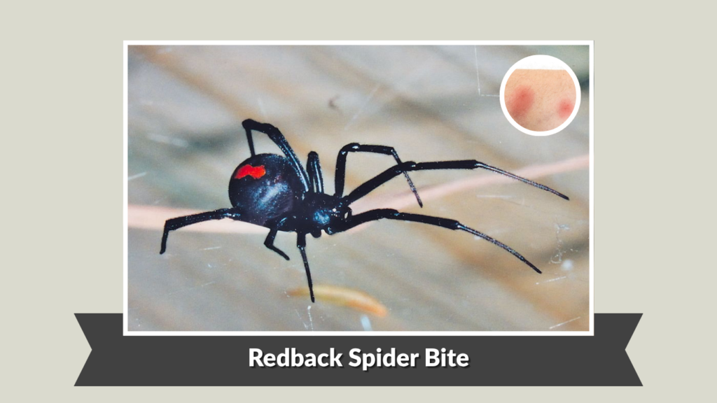 Redback Spider Bite