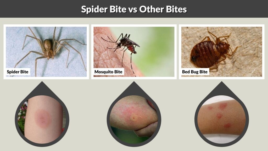 Spider Bite vs Other Bites