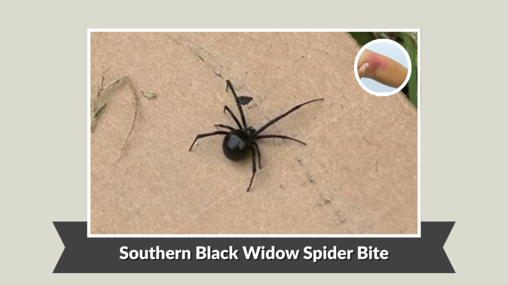 Southern Black Widow Spider Bite