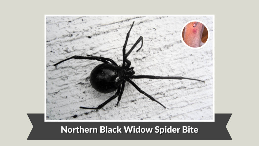 Northern Black Widow Spider Bite