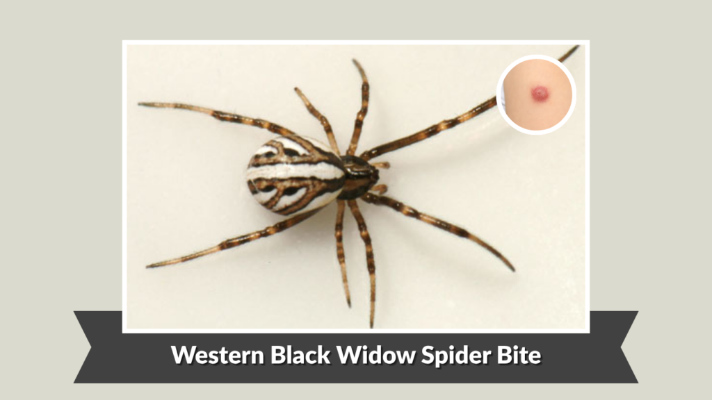 Western Black Widow Spider Bite