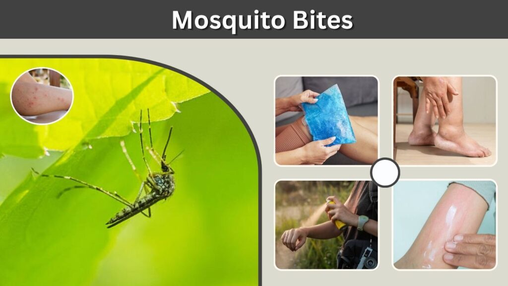 Mosquito Bites: Symptoms, Treatment, Itch Relief & Prevention