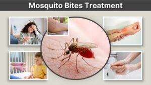 Mosquito Bites Treatment: Best Ways to Stop Itching