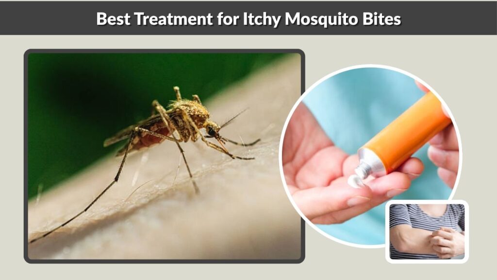 Best Treatment for Itchy Mosquito Bites