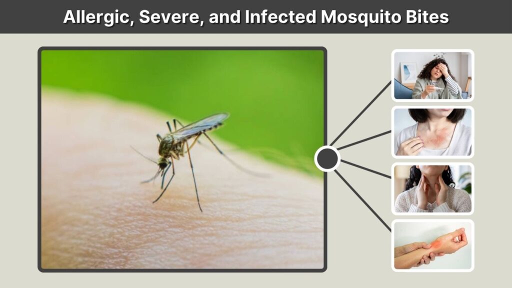 Allergic, Severe, and Infected Mosquito Bites