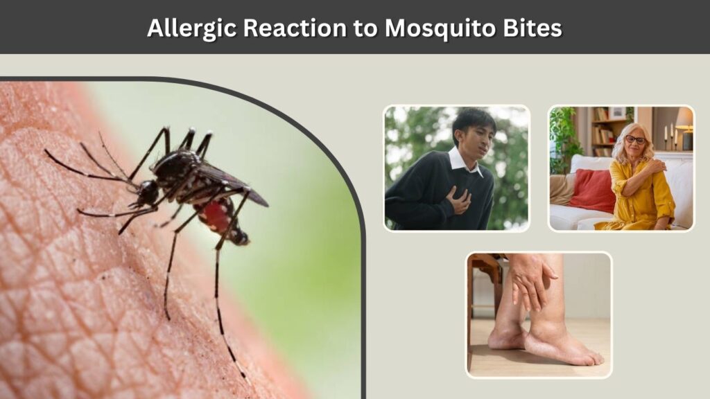 Allergic Reaction to Mosquito Bites