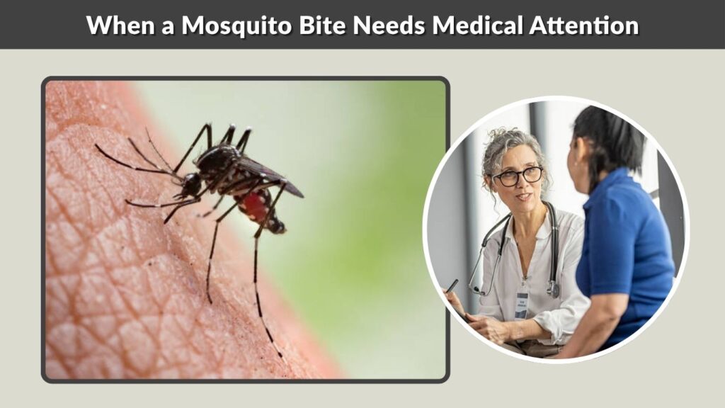 When a Mosquito Bite Needs Medical Attention