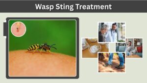 Wasp Sting Treatment: First Aid, Swelling & Home Remedies