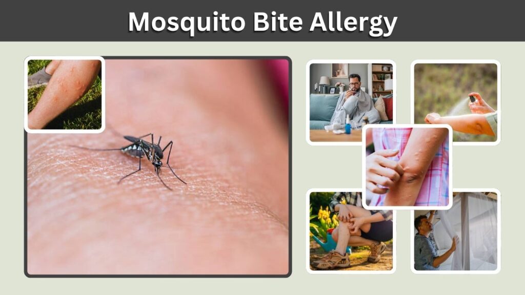 Mosquito Bite Allergy: Symptoms, Causes, and Treatment