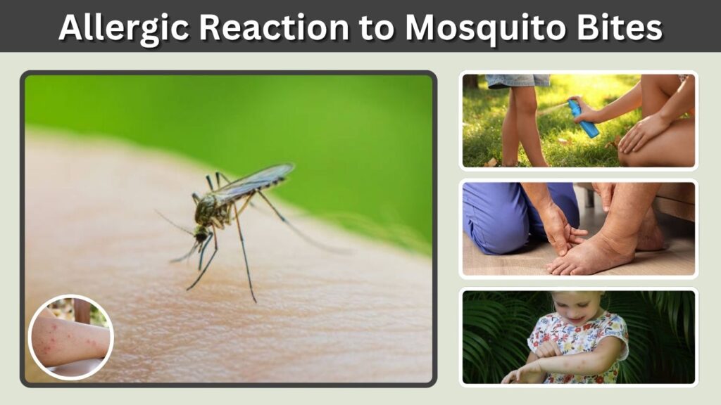 Allergic Reaction to Mosquito Bites: Symptoms and Treatment