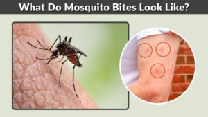 What Do Mosquito Bites Look Like? Signs & Pictures