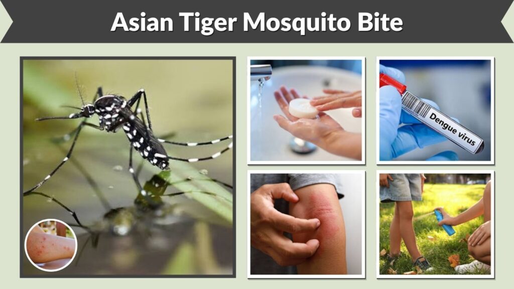 Asian Tiger Mosquito Bite: Symptoms, Risks and Treatment
